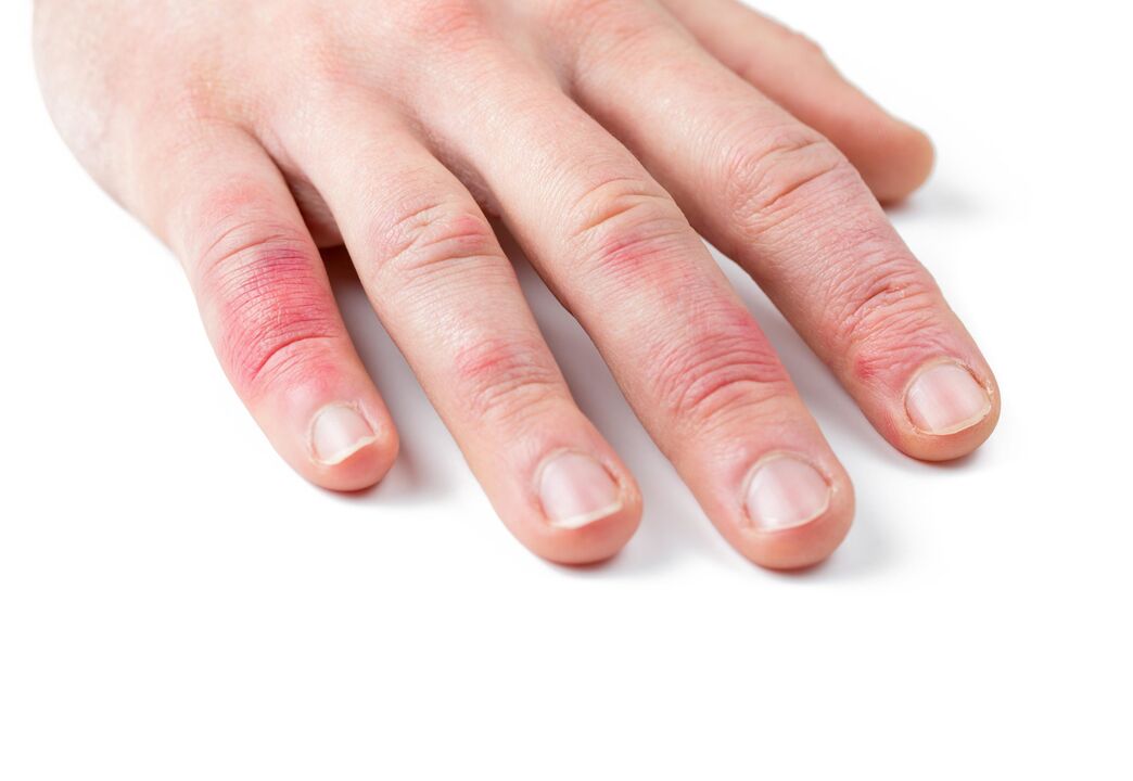 psoriasis of the hands of a child