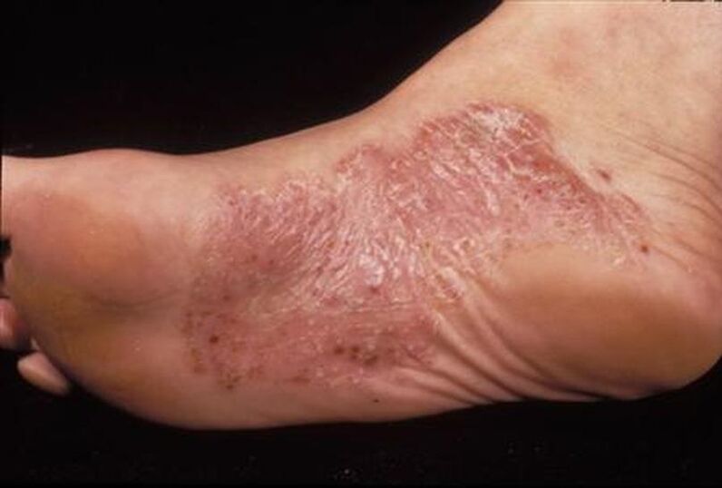 symptoms of foot psoriasis