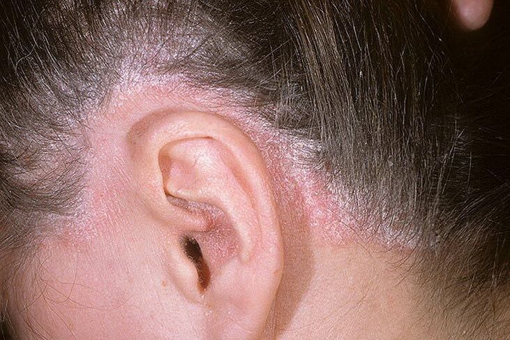 Psoriasis rash on the head behind the ears