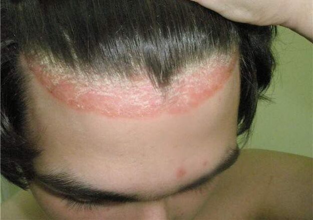 crown of psoriasis of the head