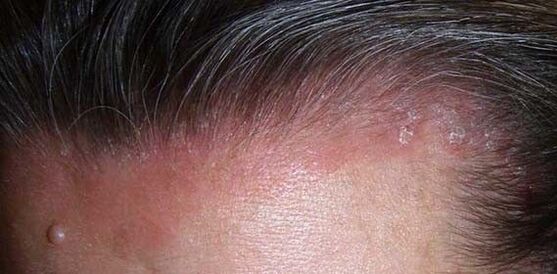 manifestation of psoriasis of the head