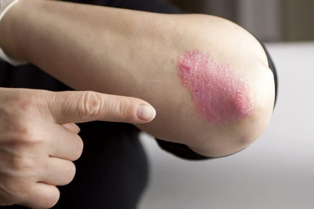 Manifestations of the initial stage of elbow psoriasis