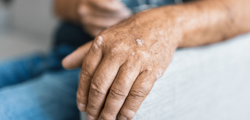Psoriasis on the skin of the hands