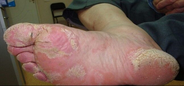 Psoriasis of the feet