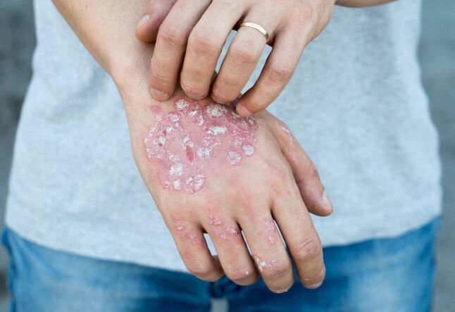 Mesitic psoriasis