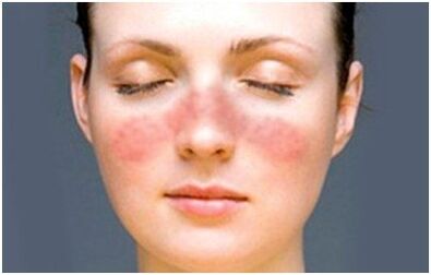 Psoriasis of the face