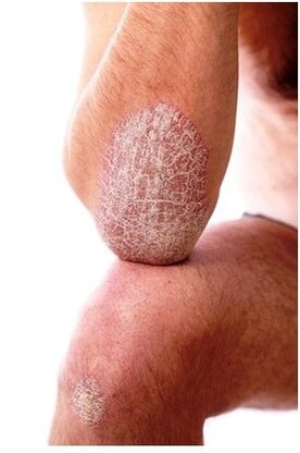 Psoriasis on the elbow