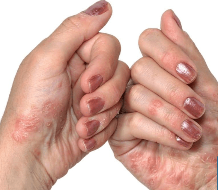 Psoriasis in the hands