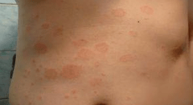 Miserable psoriasis