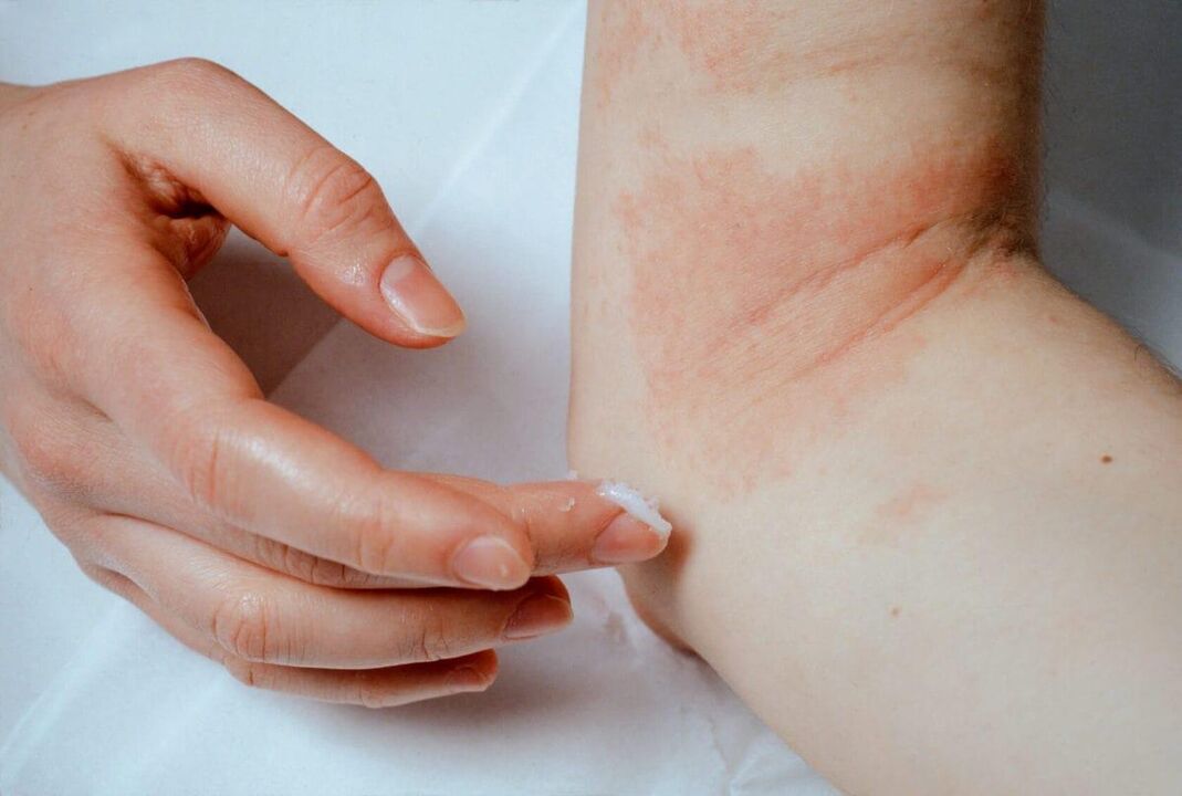 Psoriasis