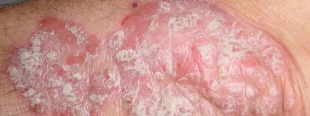 Mesitic psoriasis