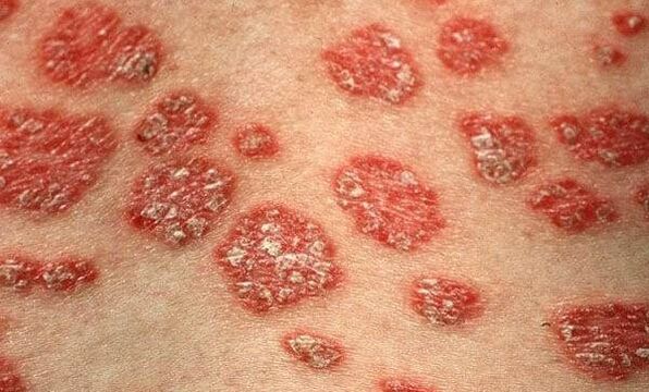 Psoriasis