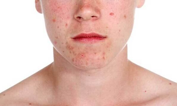 Symptoms of psoriasis