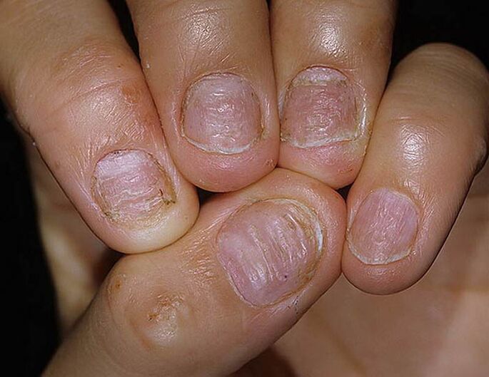 Nail psoriasis