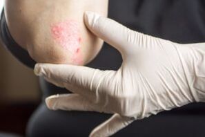 Psoriasis on the elbow
