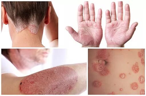 Manifestations of psoriasis on different parts of the body