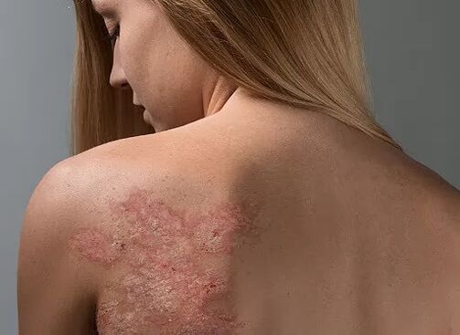 Psoriasis on the back of a girl