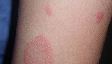 How does the initial stage of psoriasis manifest itself