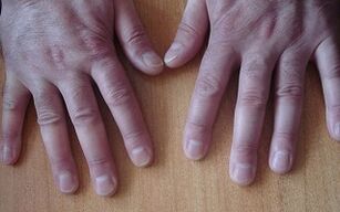 symptoms of psoriasis in the initial stage