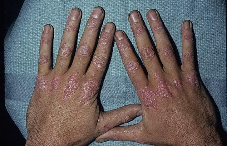 causes of the development of psoriasis of the hands