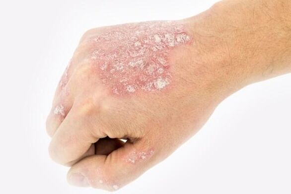 mechanism of development of hand psoriasis