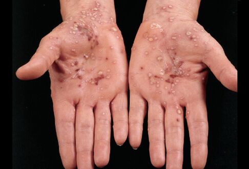 what psoriasis on the palms of the hands looks like