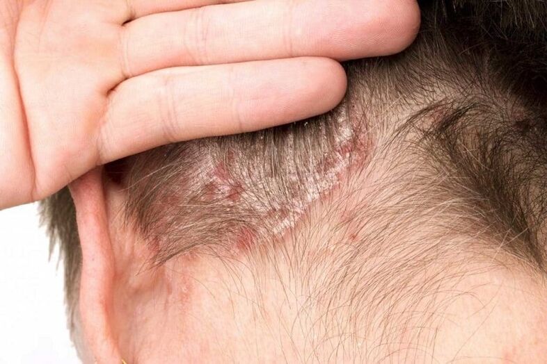 photo of psoriasis of the head