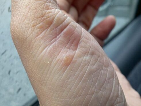 photo of psoriasis of the hand