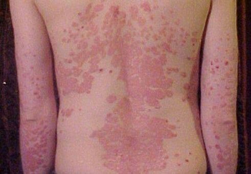 symptoms of psoriasis of the back