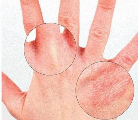 Psoriatic redness and peeling of the hand