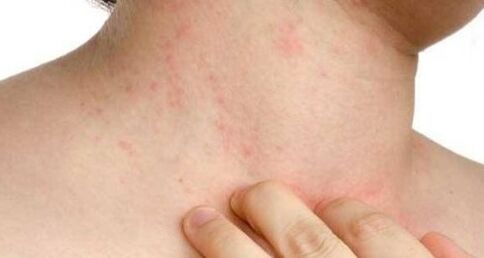 itchy skin in the early stages of psoriasis