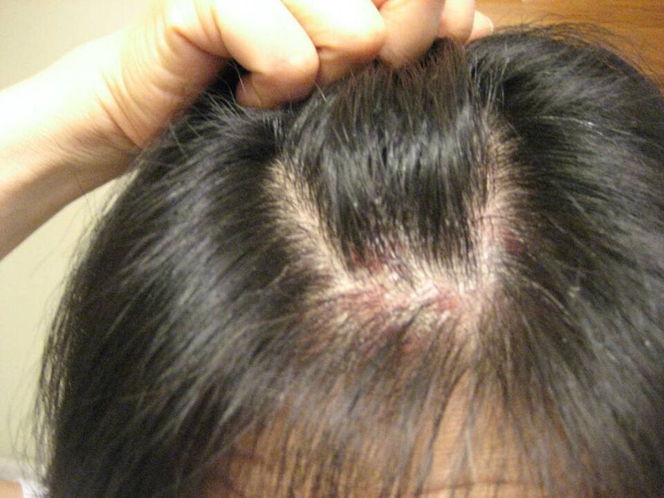 Guttate psoriasis of the head