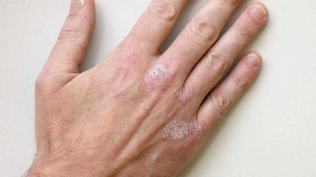Psoriasis of the hand