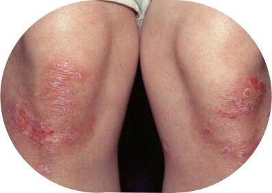 psoriasis of the elbows