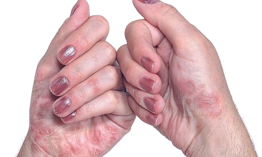 psoriasis of the hands