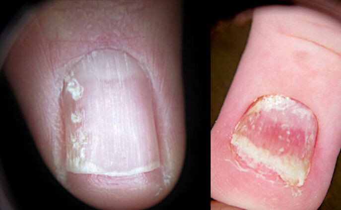 Broken nails with psoriasis