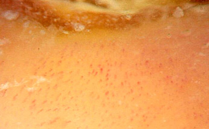 Dermatoscopy with 40-fold magnification, confirming psoriasis