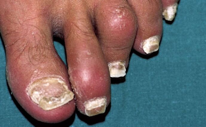 Psoriasis affecting the nails and inflammation of the joints (arthritis) of the toes