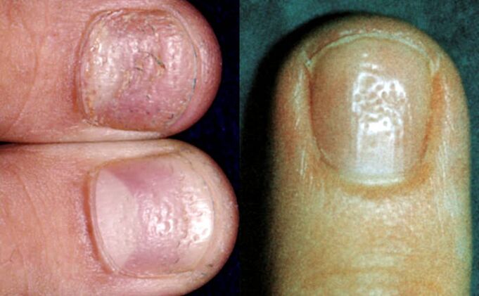 Thimble symptom - many dents on the surface of the nail plate