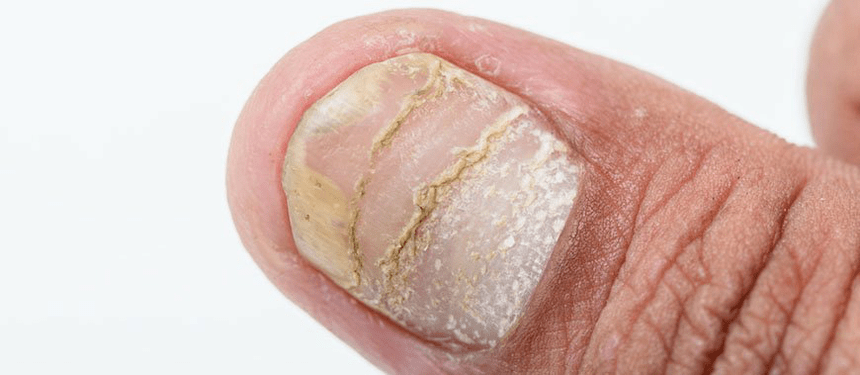 acute form of complications of nail psoriasis