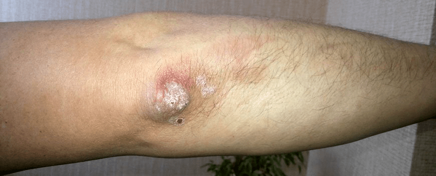 elbow psoriasis