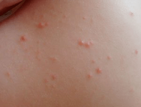 exact rash symptom of psoriasis
