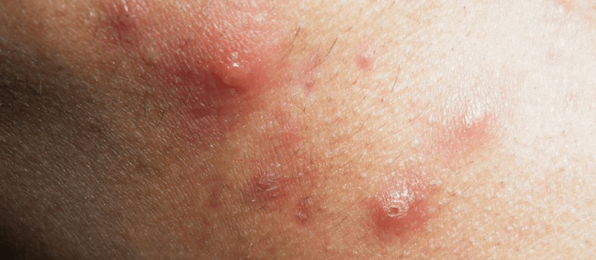 the onset of the development of guttate psoriasis in childhood