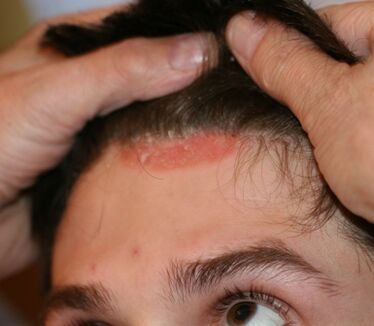 psoriasis of the head