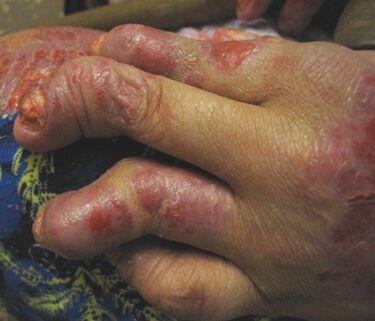neglected psoriasis of the hands